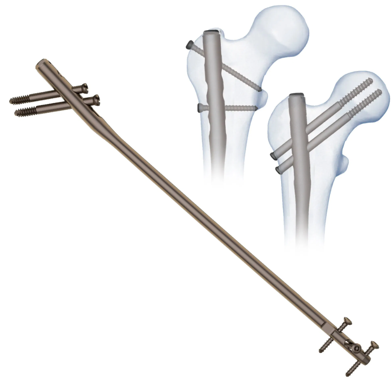 Elegant Universal Femur Nail (Cannulated)