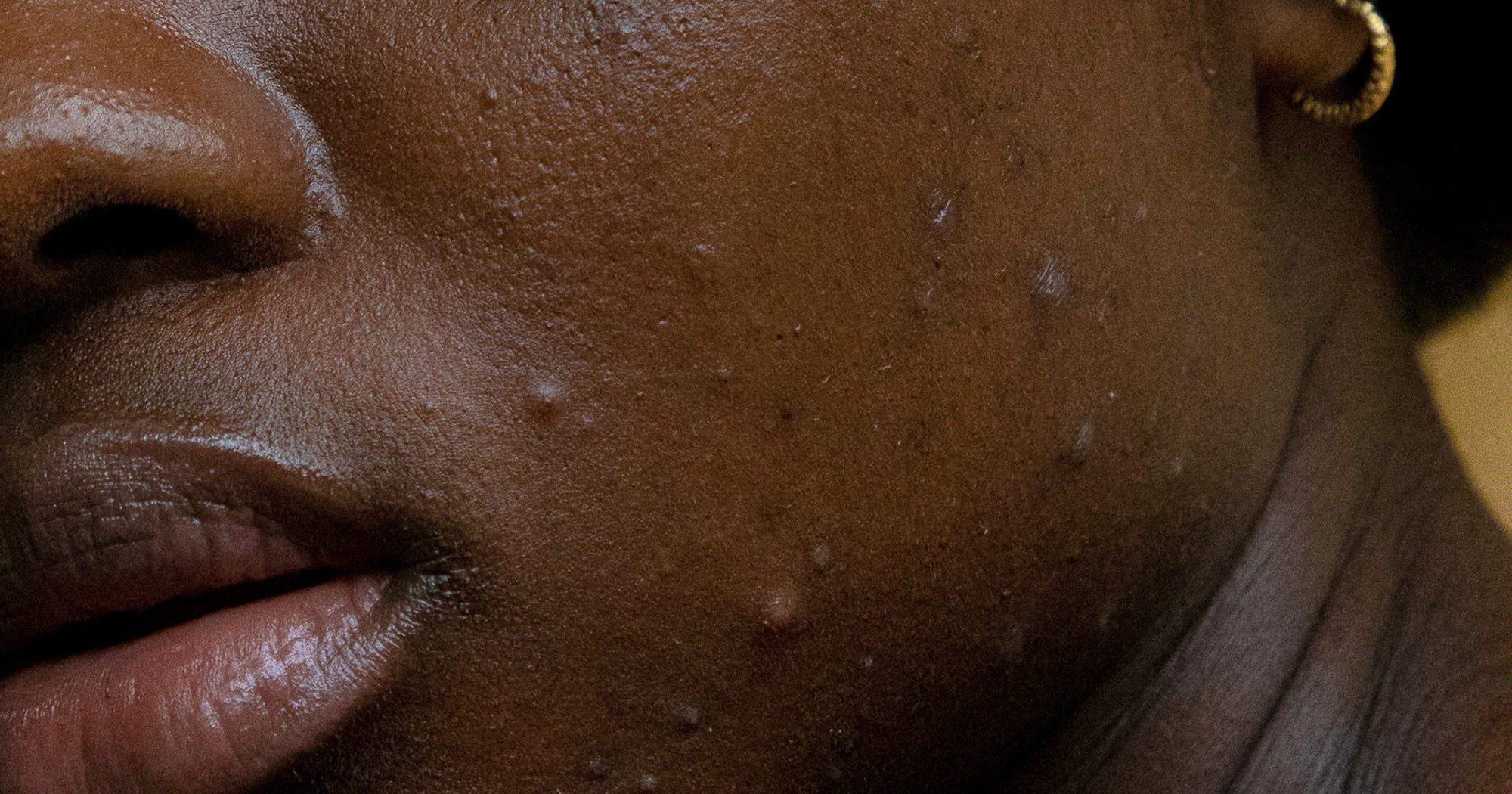 Understanding Acne: Causes, Types, and Treatment Options