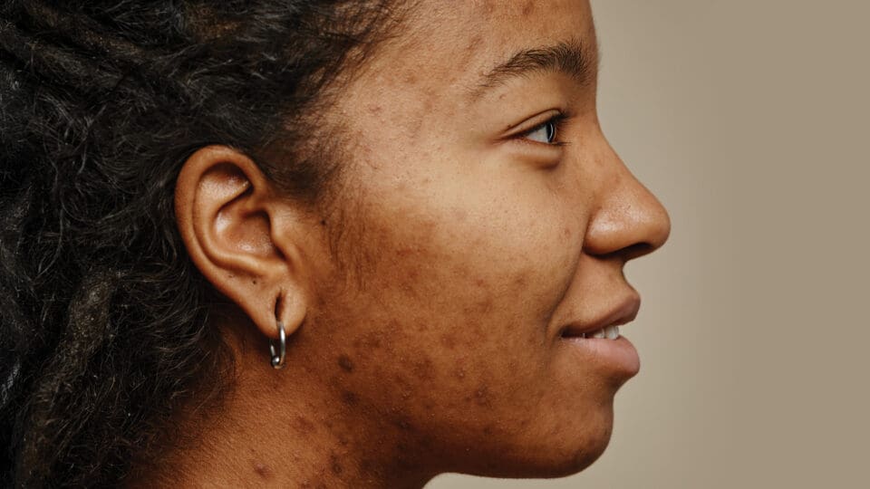 Acne in Kenyan Skin: Managing Breakouts and Hyperpigmentation